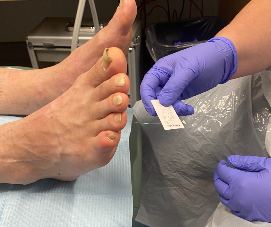 Foot Care in Dartmouth, foot care nurse administering sensation test using monofilament